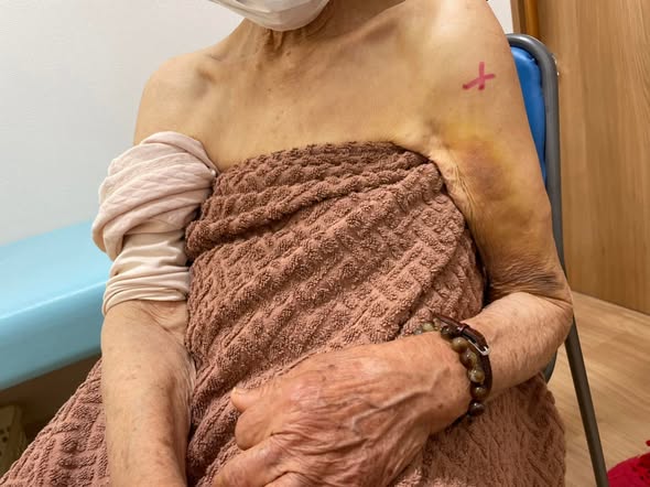 上腕骨近位端骨折（高齢者の転倒による肩の骨折）の解説イメージ