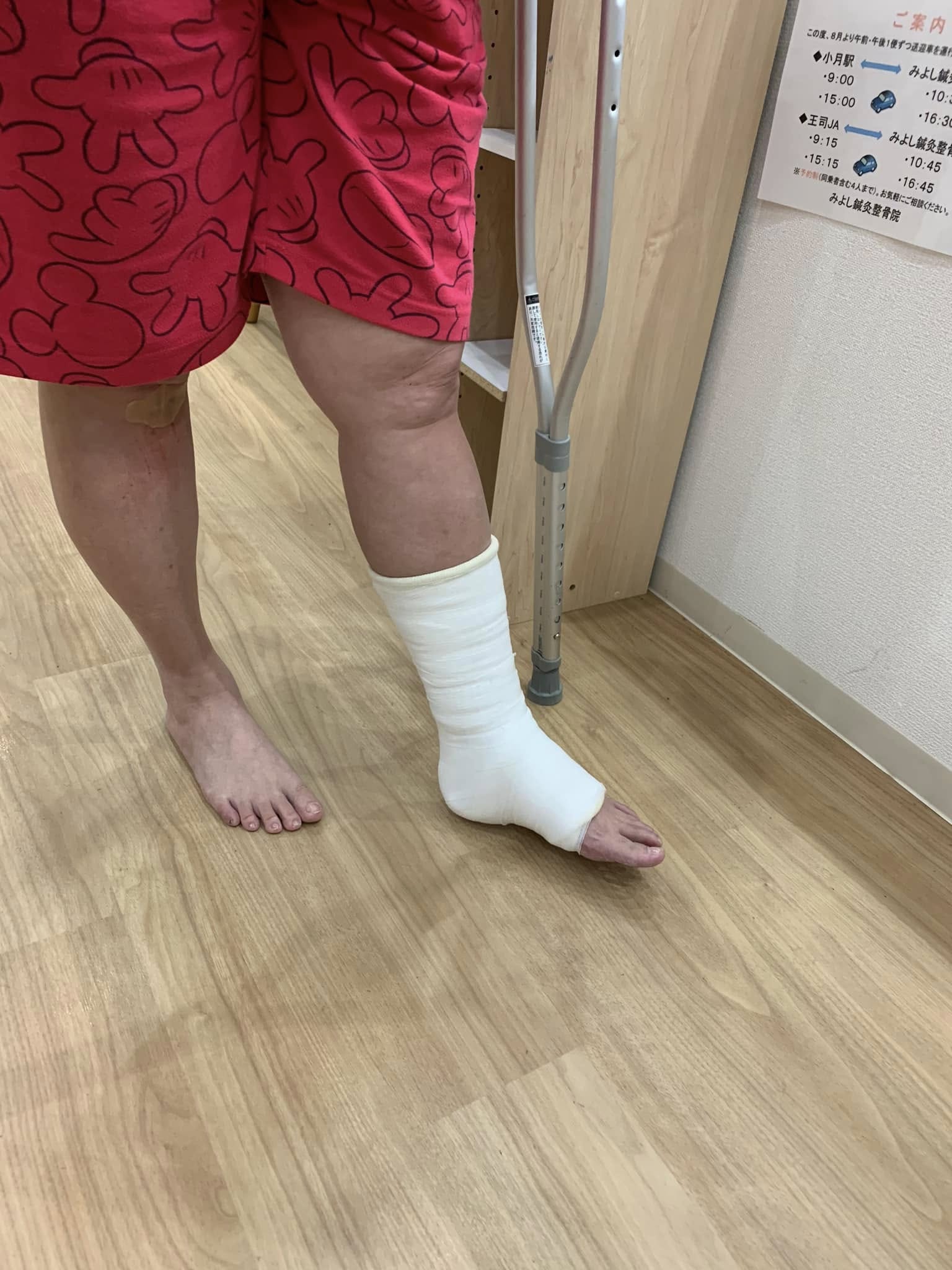下駄骨折に対するシーネ固定の様子