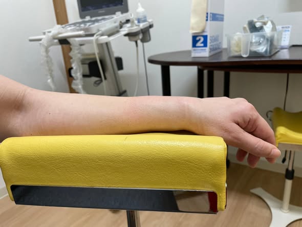 橈骨遠位端骨折・転んで手をついた後の手首の腫れの様子