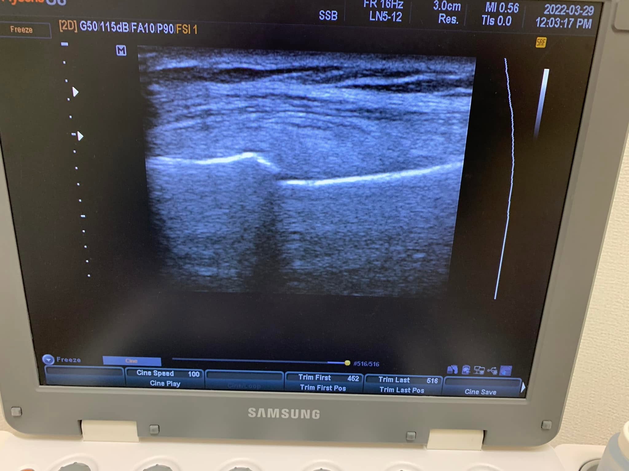 エコー（超音波画像）で上腕骨・肩まわりの状態を確認する様子